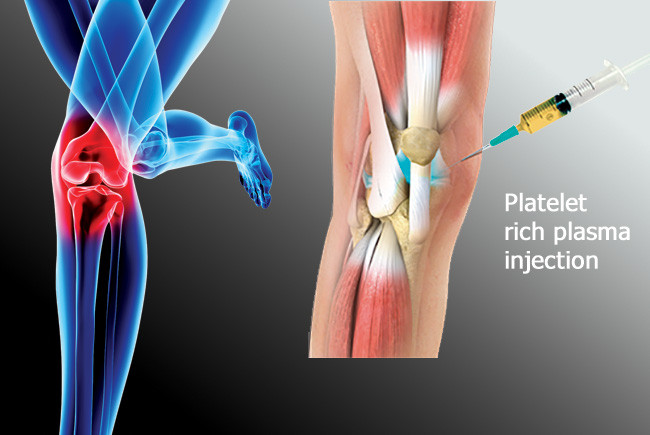 BMC for Cartilage